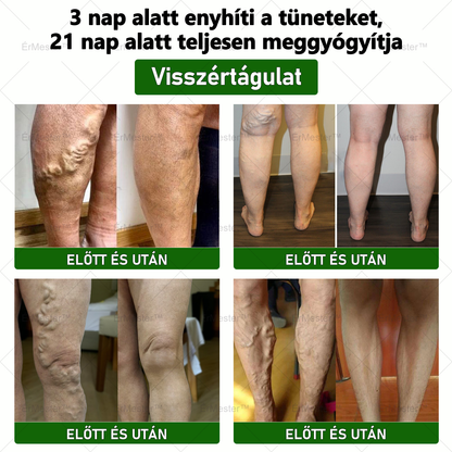 ❣️ ÉrMester™  Természetes Vénás Javító Lábfürdő Gélgolyók