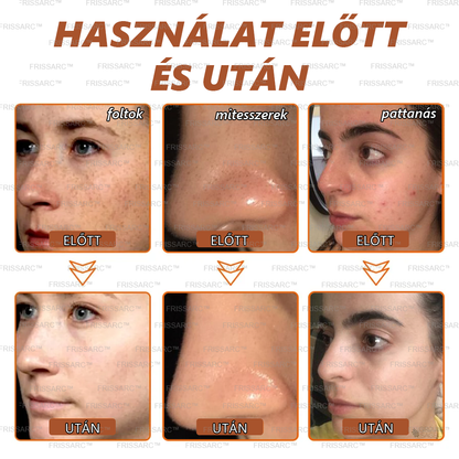 ✨ 𝐅𝐑𝐈𝐒𝐒𝐀𝐑𝐂™ Fehérítő És Folteltávolító Arcmaszk | Természetes összetevők tartósan eltüntetik a foltokat, szeplőket és napfoltokat🔥