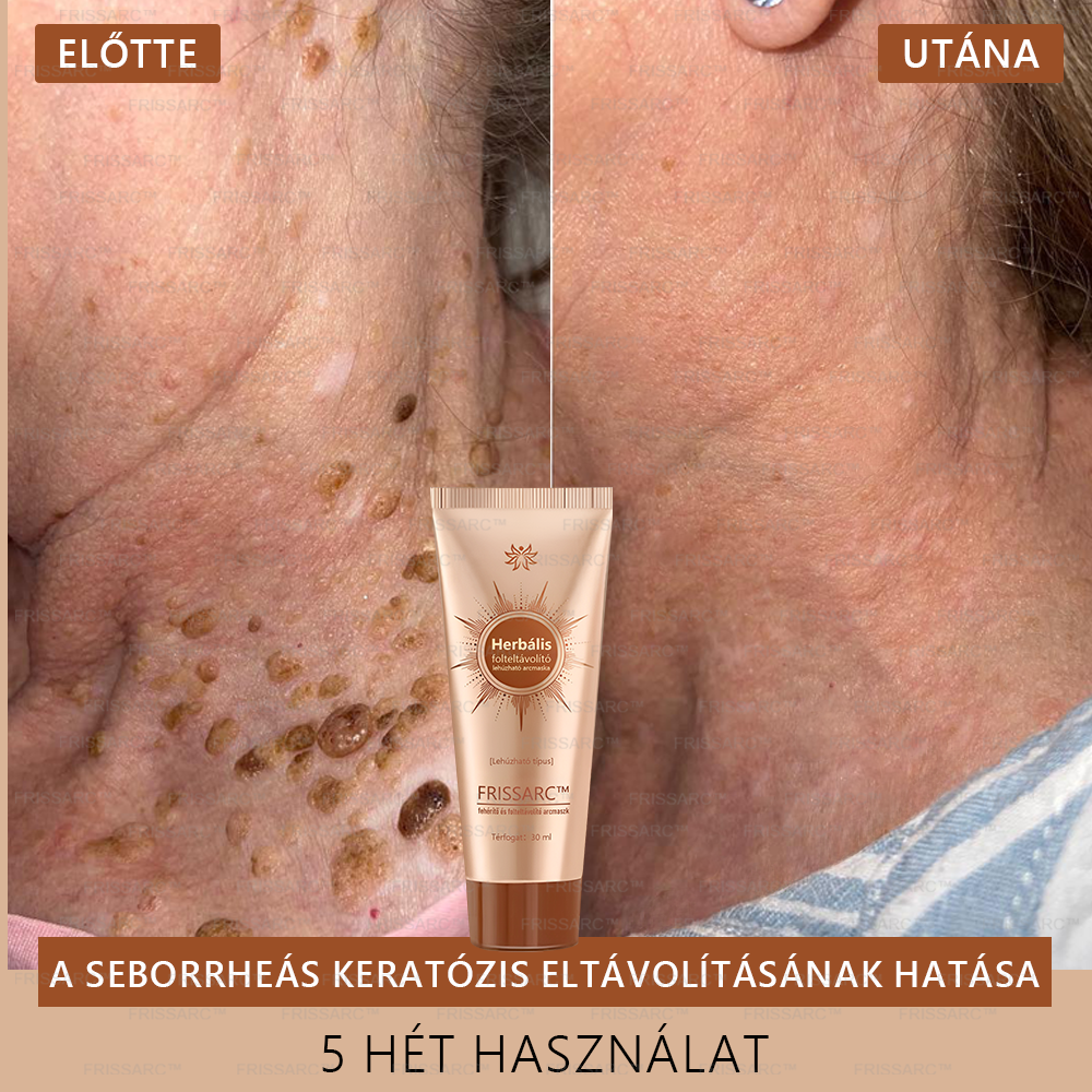 ✨ 𝐅𝐑𝐈𝐒𝐒𝐀𝐑𝐂™ Fehérítő És Folteltávolító Arcmaszk | Természetes összetevők tartósan eltüntetik a foltokat, szeplőket és napfoltokat🔥