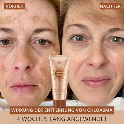 ✨ 𝐅𝐑𝐈𝐒𝐒𝐀𝐑𝐂™ Fehérítő És Folteltávolító Arcmaszk | Természetes összetevők tartósan eltüntetik a foltokat, szeplőket és napfoltokat🔥